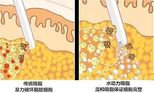 最新吸脂手術(shù)方法，探索瘦身新境界